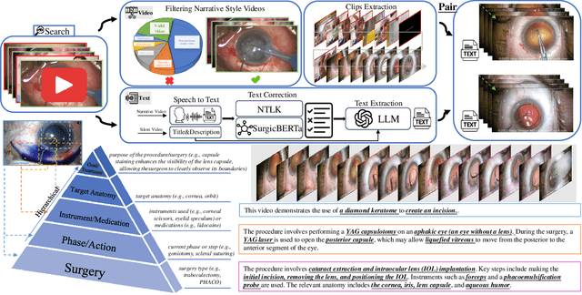 Figure 3 for OphCLIP: Hierarchical Retrieval-Augmented Learning for Ophthalmic Surgical Video-Language Pretraining