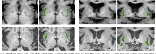 Figure 4 for A Constrast-Agnostic Method for Ultra-High Resolution Claustrum Segmentation