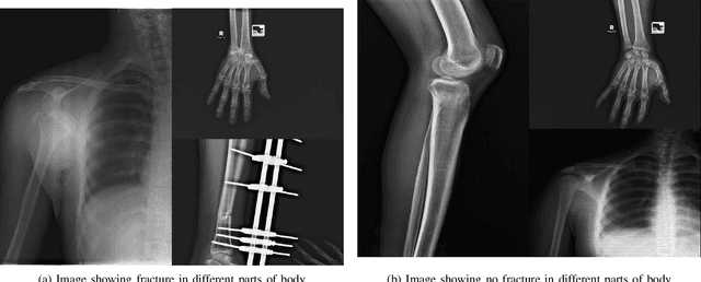 Figure 1 for A novel approach towards the classification of Bone Fracture from Musculoskeletal Radiography images using Attention Based Transfer Learning