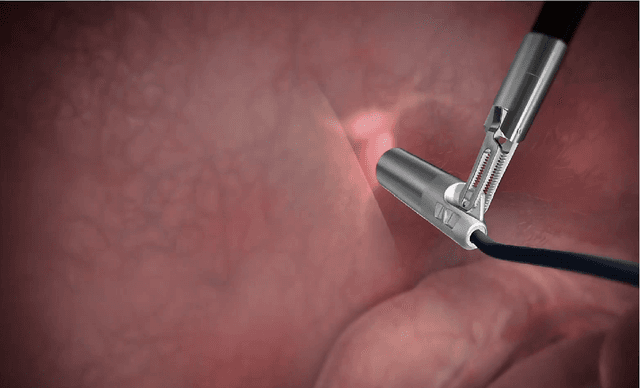 Figure 1 for Laparoscopic Scene Analysis for Intraoperative Visualisation of Gamma Probe Signals in Minimally Invasive Cancer Surgery