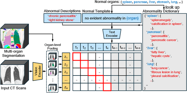 Figure 3 for CT-GLIP: 3D Grounded Language-Image Pretraining with CT Scans and Radiology Reports for Full-Body Scenarios