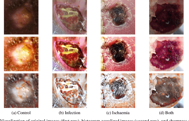 Figure 1 for Venn Diagram Multi-label Class Interpretation of Diabetic Foot Ulcer with Color and Sharpness Enhancement