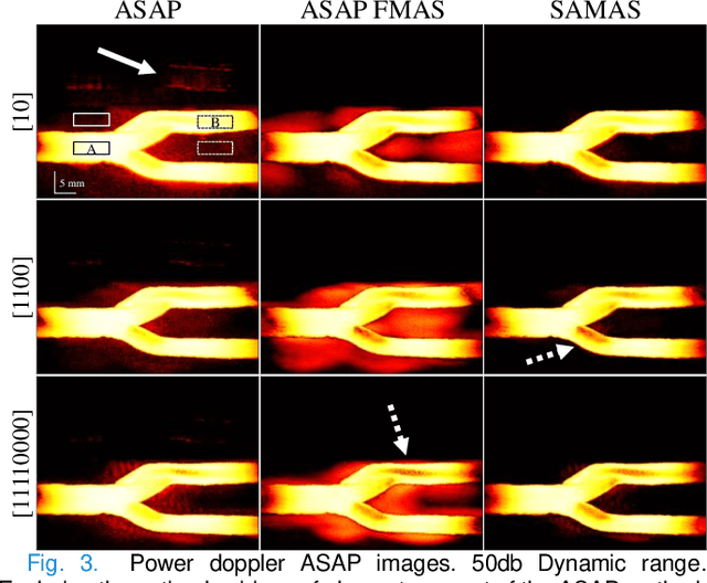 Figure 3 for Enhanced Acoustic Beamforming with Sub-Aperture Angular Multiply and Sum -- in vivo and in Human Demonstration