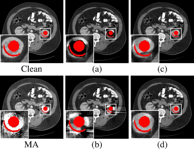 Figure 4 for Unsupervised CT Metal Artifact Reduction by Plugging Diffusion Priors in Dual Domains