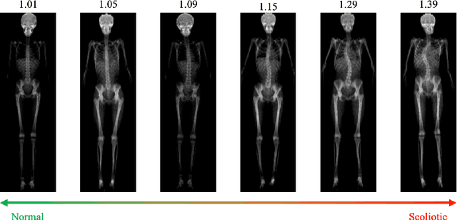 Figure 1 for Predicting Spine Geometry and Scoliosis from DXA Scans