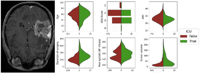 Figure 1 for Precision ICU Resource Planning: A Multimodal Model for Brain Surgery Outcomes