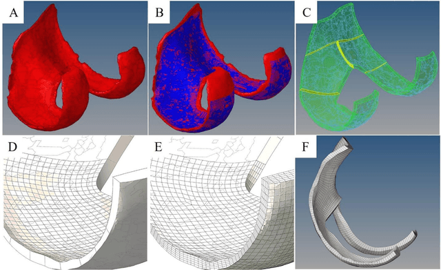 Figure 4 for Swin UNETR segmentation with automated geometry filtering for biomechanical modeling of knee joint cartilage