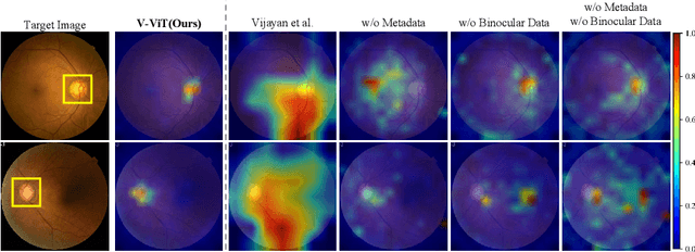 Figure 4 for Rethinking Glaucoma Calibration: Voting-Based Binocular and Metadata Integration