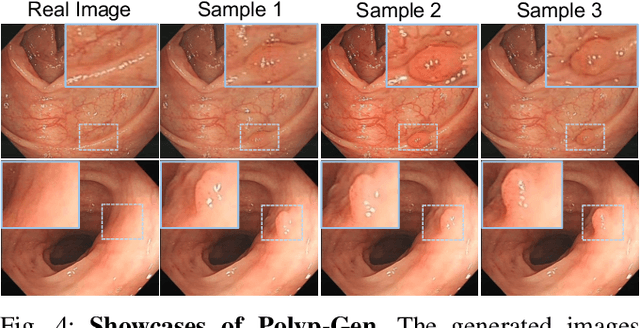 Figure 4 for Polyp-Gen: Realistic and Diverse Polyp Image Generation for Endoscopic Dataset Expansion