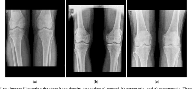 Figure 3 for Enhancing Osteoporosis Detection: An Explainable Multi-Modal Learning Framework with Feature Fusion and Variable Clustering