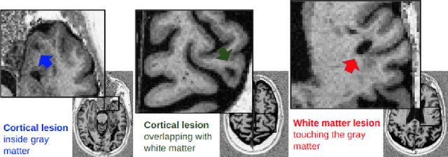 Figure 1 for Interpretability of Uncertainty: Exploring Cortical Lesion Segmentation in Multiple Sclerosis