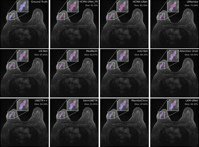 Figure 4 for HCMA-UNet: A Hybrid CNN-Mamba UNet with Inter-Slice Self-Attention for Efficient Breast Cancer Segmentation