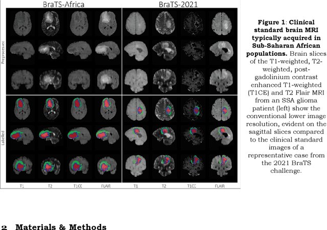 Figure 1 for The Brain Tumor Segmentation  Challenge 2023: Glioma Segmentation in Sub-Saharan Africa Patient Population 