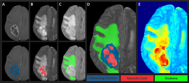 Figure 2 for The Brain Tumor Segmentation  Challenge 2023: Glioma Segmentation in Sub-Saharan Africa Patient Population 