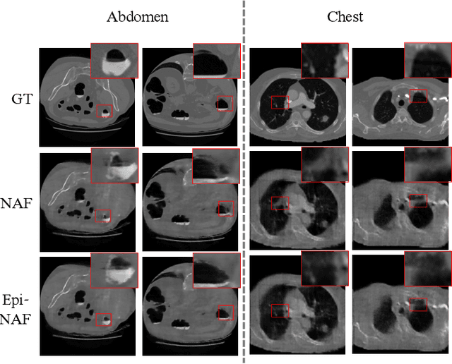 Figure 4 for Epi-NAF: Enhancing Neural Attenuation Fields for Limited-Angle CT with Epipolar Consistency Conditions