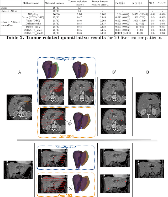 Figure 4 for Registration of Longitudinal Liver Examinations for Tumor Progress Assessment
