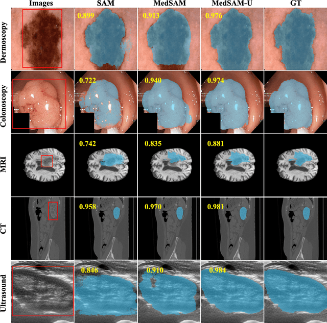 Figure 3 for MedSAM-U: Uncertainty-Guided Auto Multi-Prompt Adaptation for Reliable MedSAM