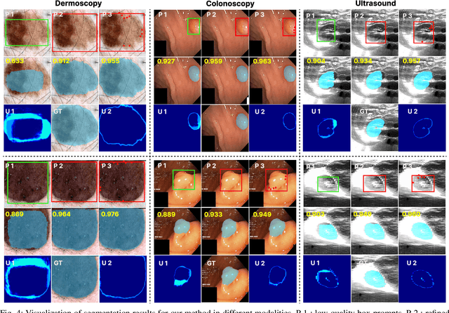 Figure 4 for MedSAM-U: Uncertainty-Guided Auto Multi-Prompt Adaptation for Reliable MedSAM