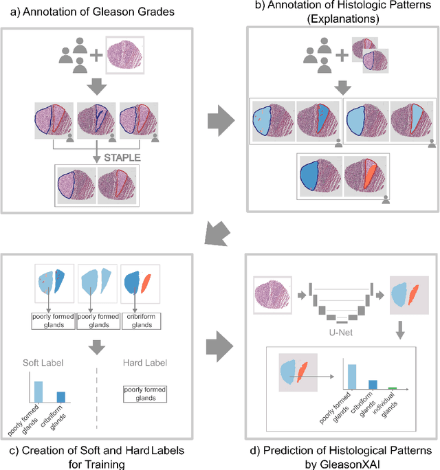 Figure 1 for Pathologist-like explainable AI for interpretable Gleason grading in prostate cancer