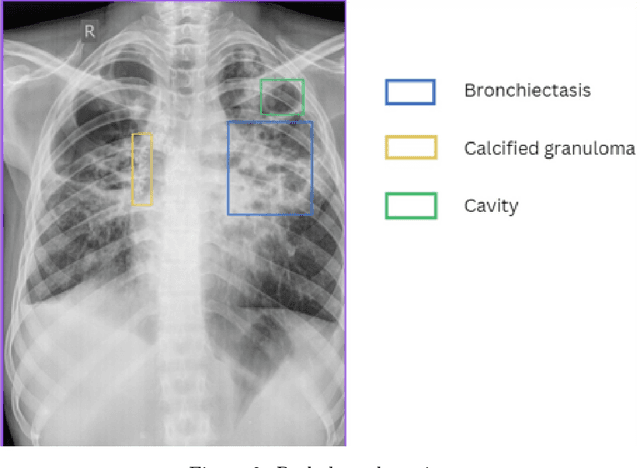 Figure 3 for Advancing Chronic Tuberculosis Diagnostics Using Vision-Language Models: A Multi modal Framework for Precision Analysis