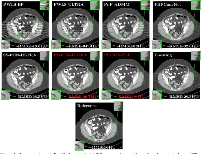 Figure 4 for Enhancing Low-dose CT Image Reconstruction by Integrating Supervised and Unsupervised Learning