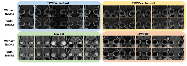 Figure 3 for Super-Resolution Multi-Contrast Unbiased Eye Atlases With Deep Probabilistic Refinement