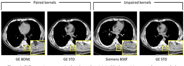 Figure 1 for Inter-vendor harmonization of Computed Tomography (CT) reconstruction kernels using unpaired image translation