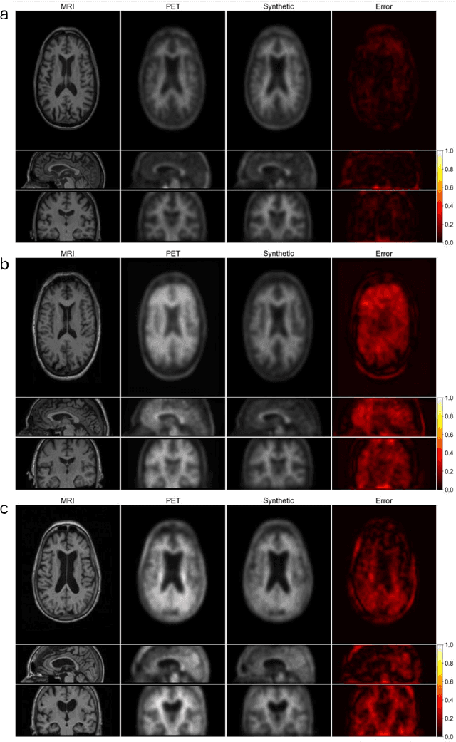 Figure 2 for Synthesizing beta-amyloid PET images from T1-weighted Structural MRI: A Preliminary Study