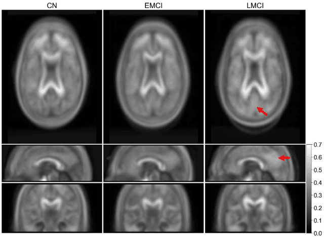 Figure 3 for Synthesizing beta-amyloid PET images from T1-weighted Structural MRI: A Preliminary Study