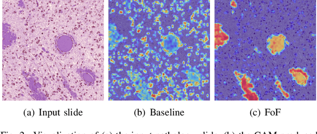 Figure 2 for Focus on Focus: Focus-oriented Representation Learning and Multi-view Cross-modal Alignment for Glioma Grading