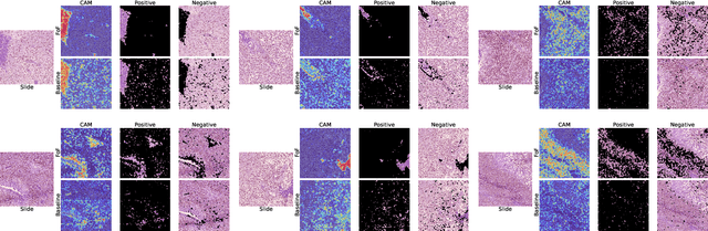 Figure 4 for Focus on Focus: Focus-oriented Representation Learning and Multi-view Cross-modal Alignment for Glioma Grading