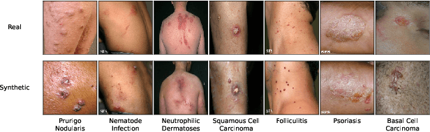 Figure 4 for From Majority to Minority: A Diffusion-based Augmentation for Underrepresented Groups in Skin Lesion Analysis