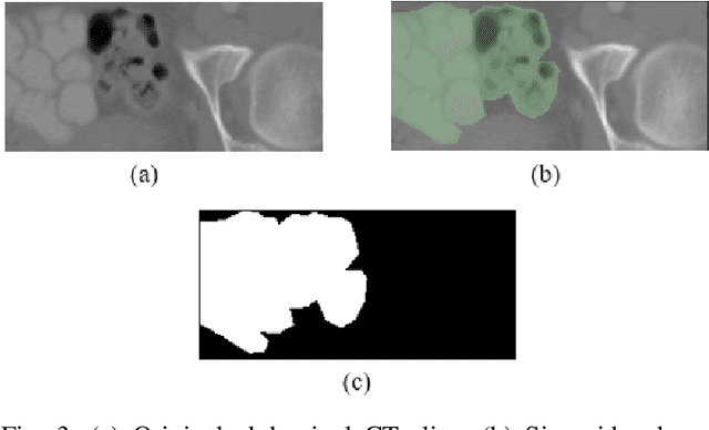 Figure 3 for Attention and Pooling based Sigmoid Colon Segmentation in 3D CT images