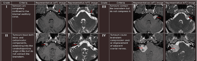 Figure 1 for Koos Classification of Vestibular Schwannoma via Image Translation-Based Unsupervised Cross-Modality Domain Adaptation