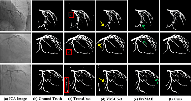 Figure 1 for SFD-Mamba2Net: Strcture-Guided Frequency-Enhanced Dual-Stream Mamba2 Network for Coronary Artery Segmentation