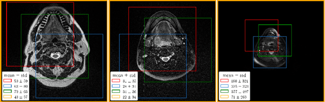 Figure 3 for Improving the U-Net Configuration for Automated Delineation of Head and Neck Cancer on MRI