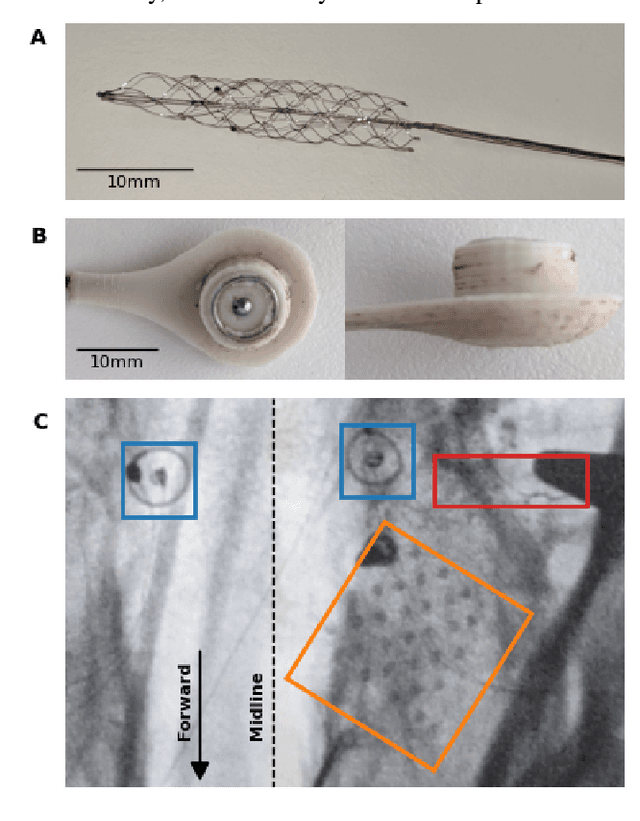 Figure 1 for Comparison of Sub-Scalp EEG and Endovascular Stent-Electrode Array for Visual Evoked Potential Brain-Computer Interface