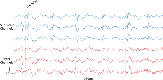 Figure 2 for Comparison of Sub-Scalp EEG and Endovascular Stent-Electrode Array for Visual Evoked Potential Brain-Computer Interface