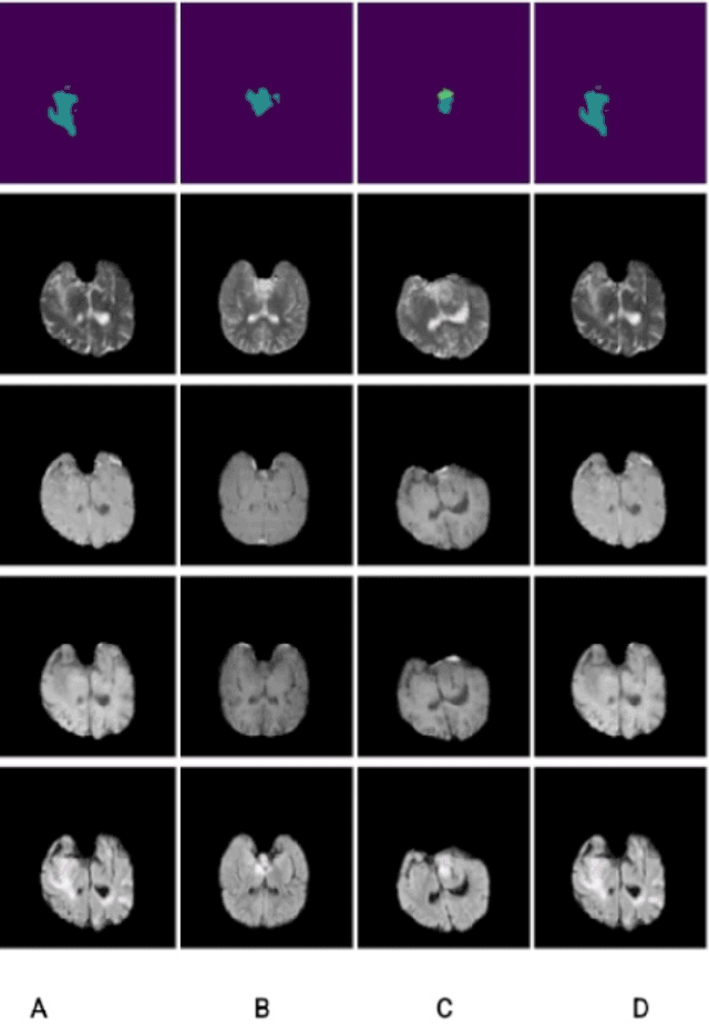 Figure 3 for Generative Style Transfer for MRI Image Segmentation: A Case of Glioma Segmentation in Sub-Saharan Africa