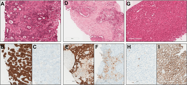 Figure 2 for Primary liver cancer classification from routine tumour biopsy using weakly supervised deep learning