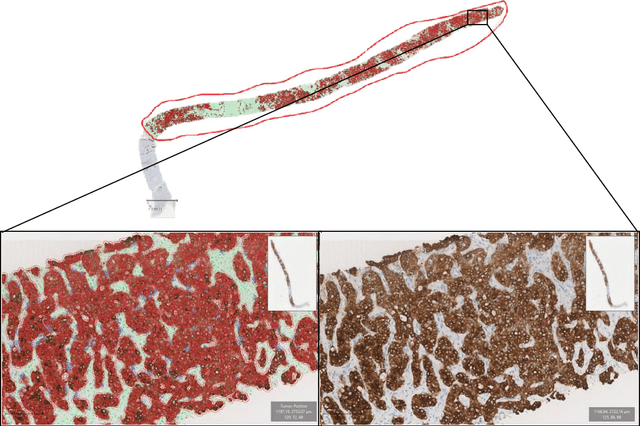 Figure 3 for Primary liver cancer classification from routine tumour biopsy using weakly supervised deep learning