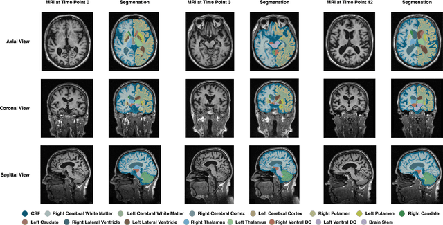 Figure 3 for MINDSETS: Multi-omics Integration with Neuroimaging for Dementia Subtyping and Effective Temporal Study