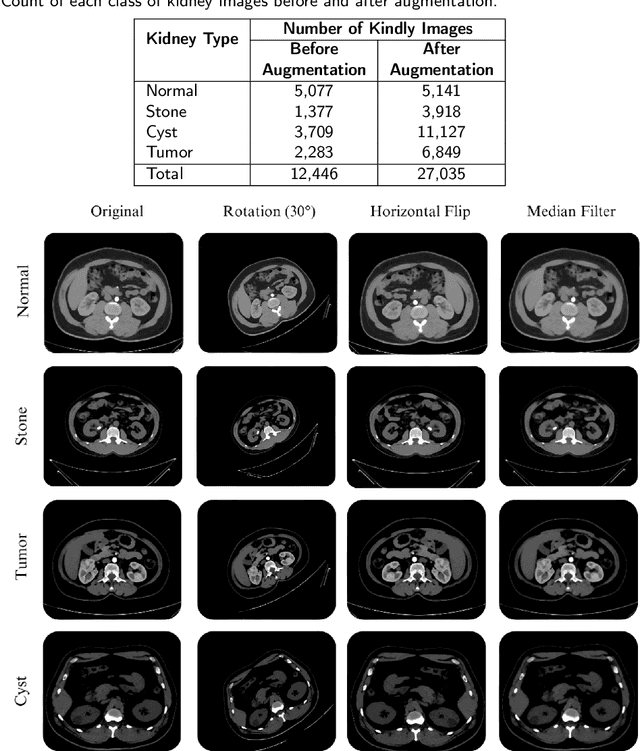 Figure 2 for Hybrid Deep Learning Framework for Classification of Kidney CT Images: Diagnosis of Stones, Cysts, and Tumors