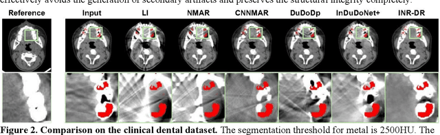 Figure 3 for Diffusion Model Regularized Implicit Neural Representation for CT Metal Artifact Reduction