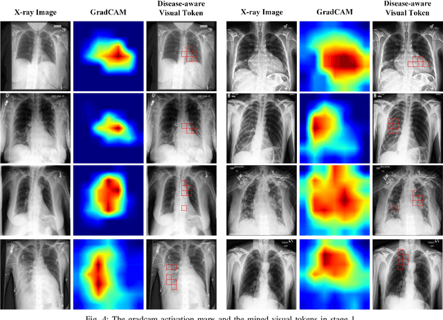 Figure 4 for Activating Associative Disease-Aware Vision Token Memory for LLM-Based X-ray Report Generation