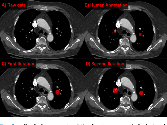 Figure 3 for Label up: Learning Pulmonary Embolism Segmentation from Image Level Annotation through Model Explainability