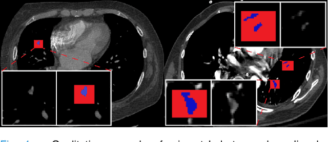 Figure 4 for Label up: Learning Pulmonary Embolism Segmentation from Image Level Annotation through Model Explainability