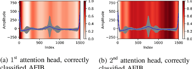 Figure 3 for Deciphering Heartbeat Signatures: A Vision Transformer Approach to Explainable Atrial Fibrillation Detection from ECG Signals