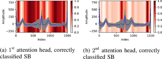 Figure 4 for Deciphering Heartbeat Signatures: A Vision Transformer Approach to Explainable Atrial Fibrillation Detection from ECG Signals