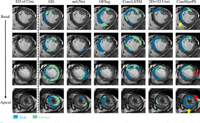 Figure 3 for CineMyoPS: Segmenting Myocardial Pathologies from Cine Cardiac MR